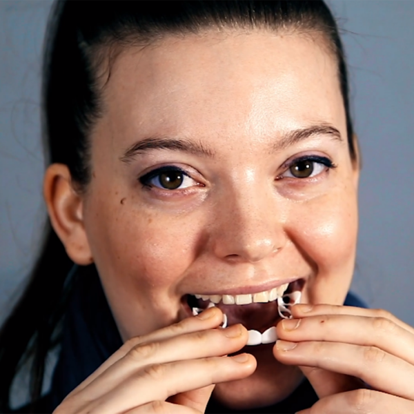 Shiny Smile Veneers 2